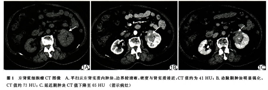左肾浆细胞瘤CT表现1例